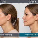 Facial balancing before and after results showing improved facial harmony