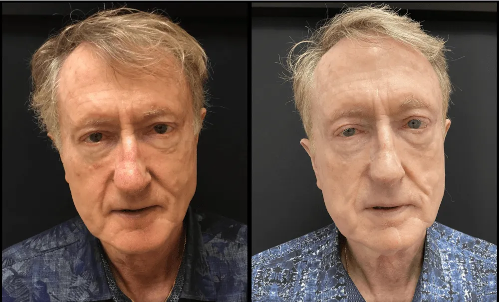 sculptra vs Filers