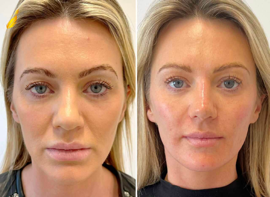 Facial Balancing Before and After results